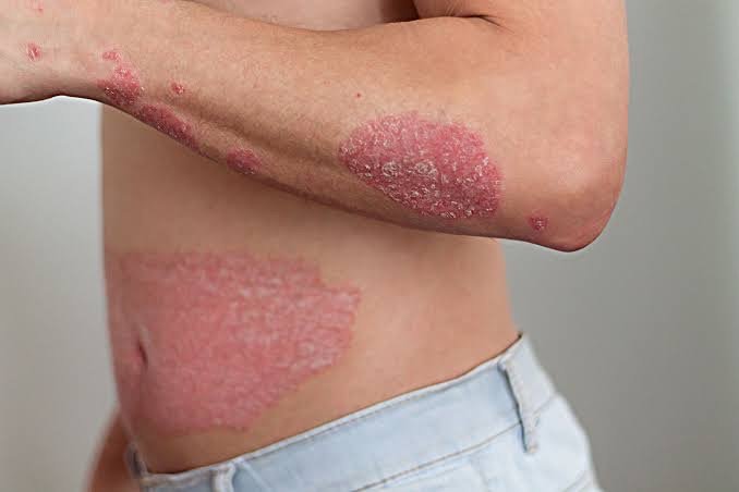 Psoriasis Treatment (1)