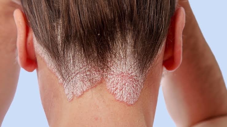 Psoriasis Treatment (2)