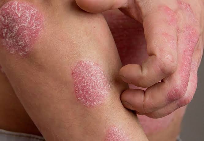 Psoriasis Treatment (3)