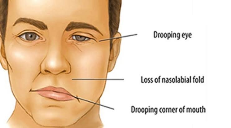 Facial Paralysis (2)