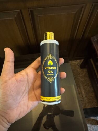 Ayurdhama Vitiligo Oil photo review