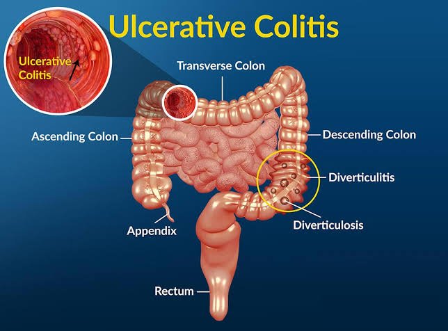 ulcerative colitis