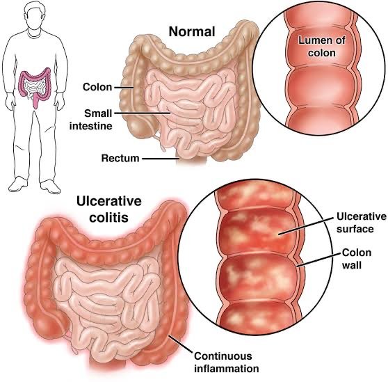 ulcerative colitis