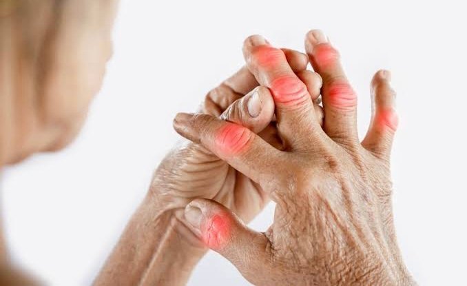 Rheumatoid arthritis