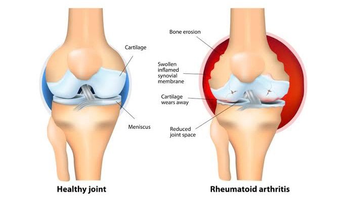 Rheumatoid arthritis