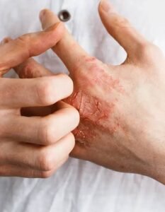 Eczema