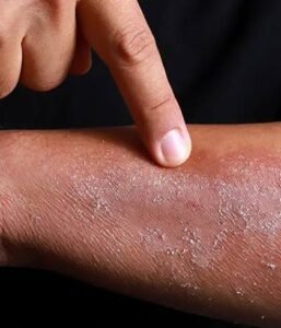 Eczema
