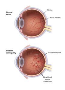 Diabetic retinopathy