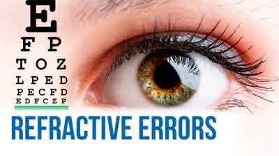 Refractive errors