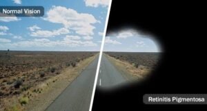 Retinitis Pigmentosa