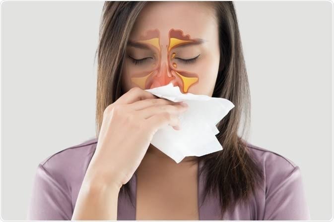 allergic rhinitis