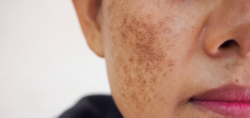 Melasma